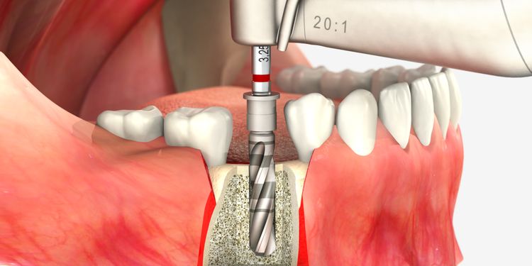 2 - Khoan tạo lỗ cho trụ Implant