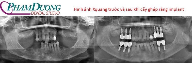 Ưu điểm mà cấy ghép răng implant mang lại là gì?