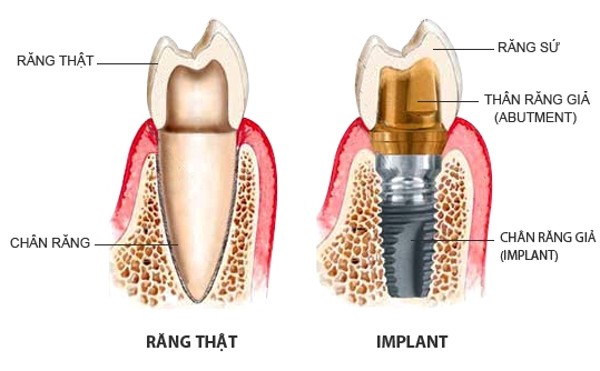 Cấy ghép răng implant là gì?