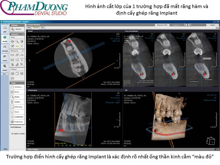 Trường hợp cấy ghép răng implant