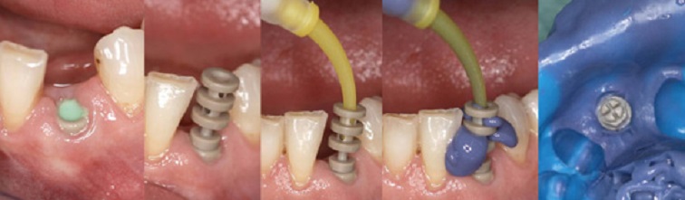 Phục hình răng cố định trên Implant