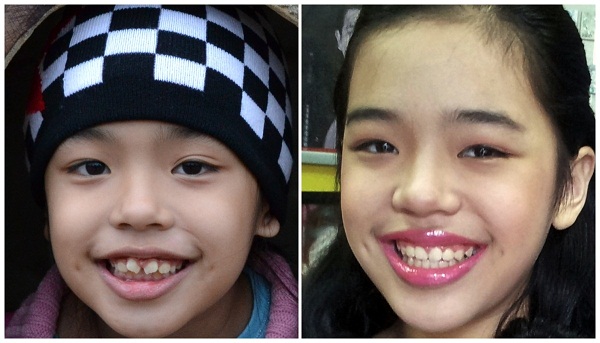 Khuôn mặt với sự phát triển đúng của cung hàm sau khi sử dụng MyObrace