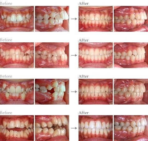 Một số thành quả của chỉnh nha