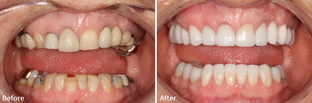 Răng sứ không kim loại