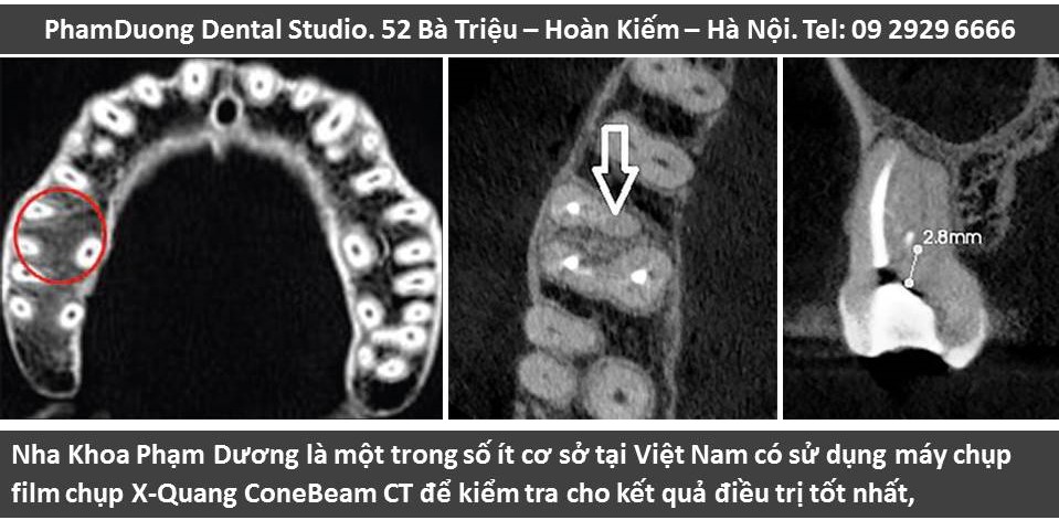 Film chụp X-quang Nha Khoa Phạm Dương