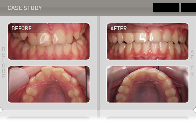sử dụng máng đeo MyoBrace