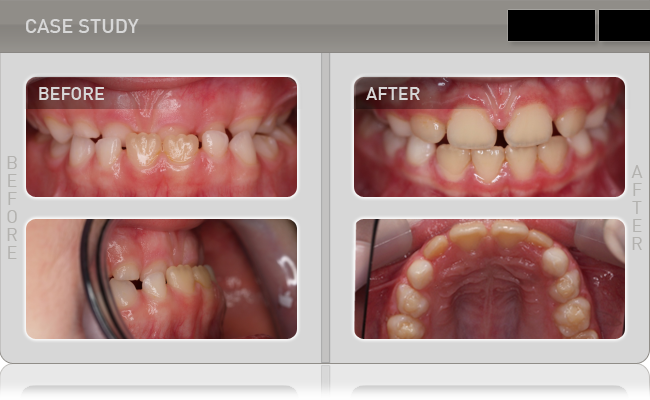 trẻ em trên toàn thế giới sử dụng máng đeo MyoBrace