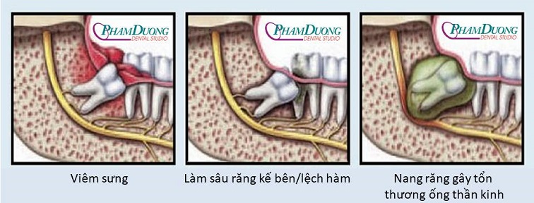 Tại sao nên nhổ răng khôn?