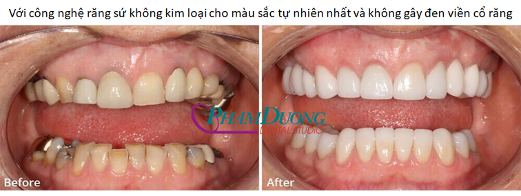 RĂNG SỨ ƯU VIỆT KHÔNG KIM LOẠI