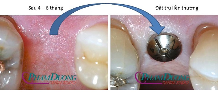 Đặt trụ lành thương lên Implant