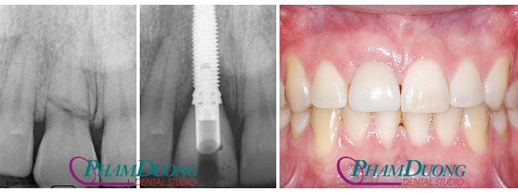 Trường hợp chân răng bị gãy do tai nạn được cấy ghép Implant