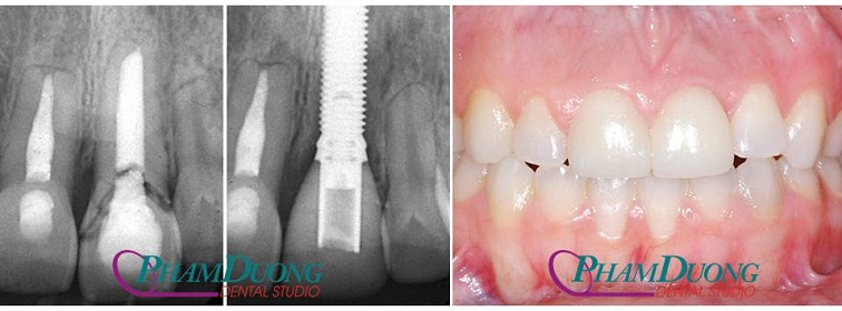 Trường hợp răng bị nứt gãy do điều trị tủy lâu năm được cấy ghép Implant
