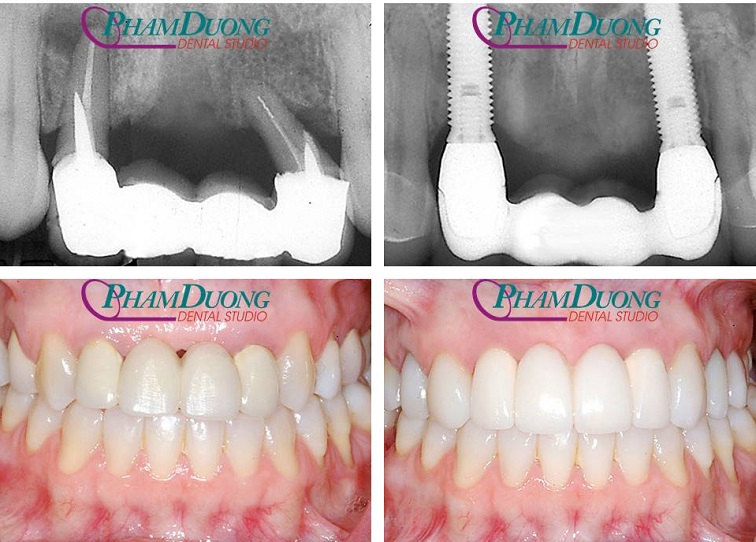 Trường hợp cầu răng cửa lung lay do điều trị tủy lâu năm được cấy ghép Implant