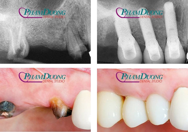Trường hợp cầu răng hàm gẫy thân răng do điều trị tủy lâu năm được cấy Implant