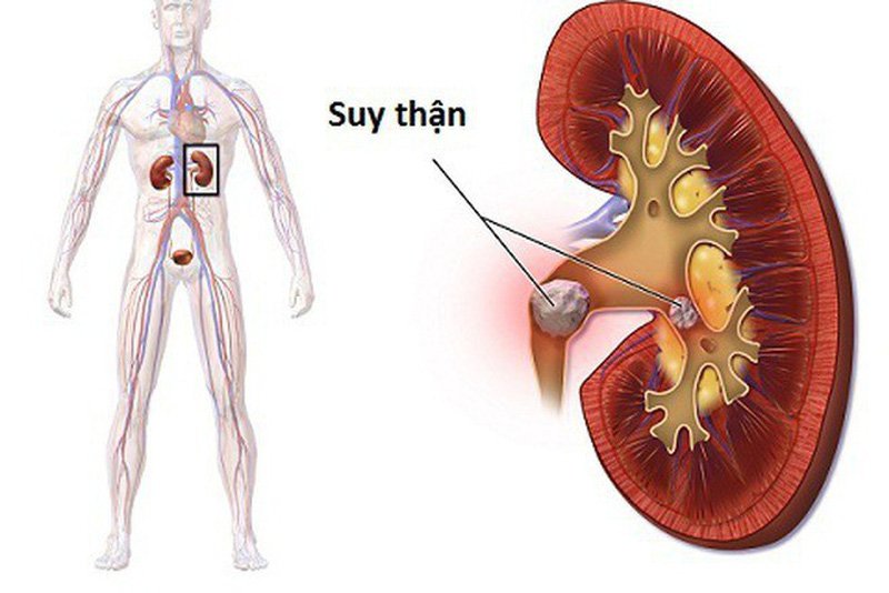 Thực hư việc chữa suy thận bằng thuốc nam liệu có hiệu quả như lời đồn?