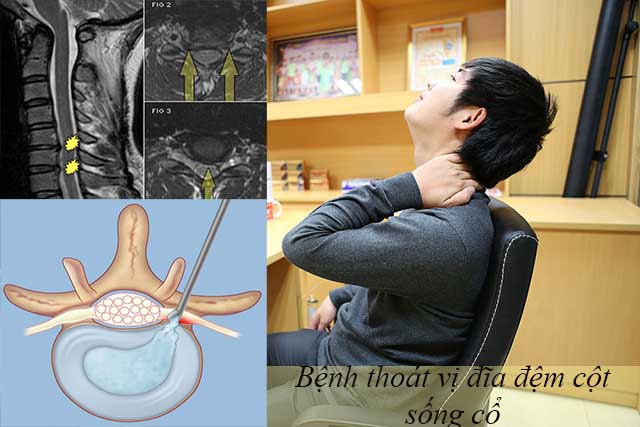 thoát vị đĩa đệm đốt sống cổ
