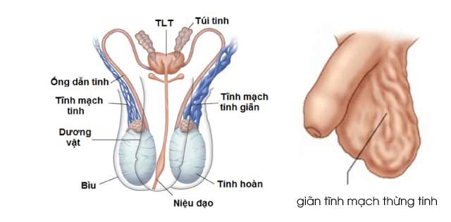 Giãn tĩnh mạch thừng tinh - Nguyên nhân triệu chứng, cách phòng và điều trị
