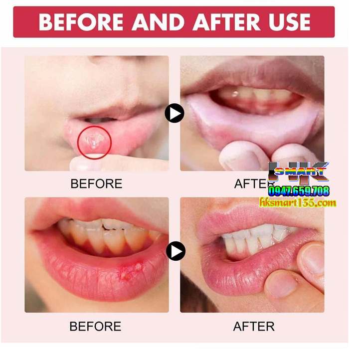 Gel Làm Dịu Giảm Đau Răng Miệng Mouth Oral Ulcer 30gr