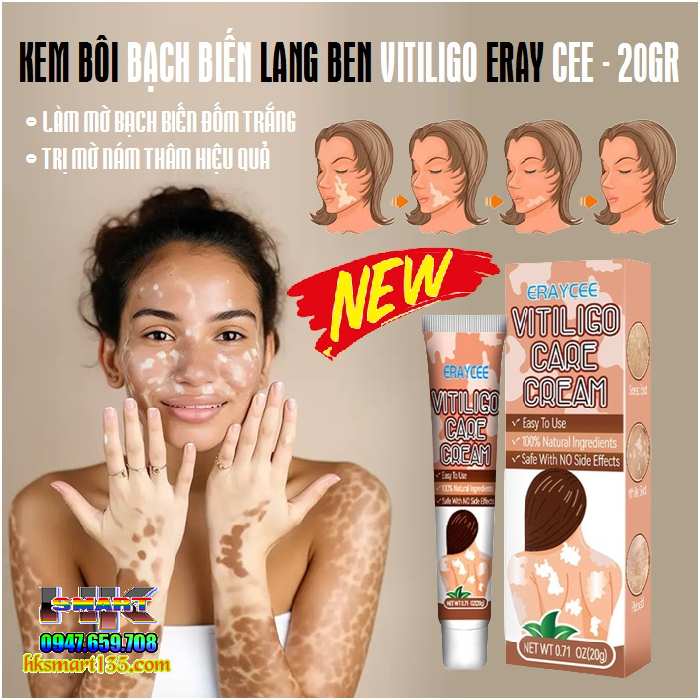 Kem bôi bạch biến lang ben Vitiligo ERAY CEE- 20gr làm mờ bạch biến đốm trắng