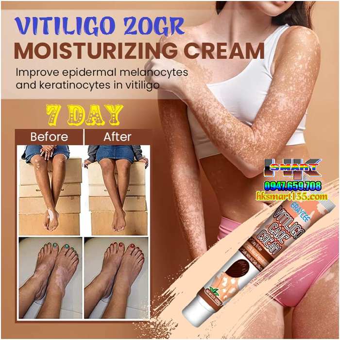 Kem bôi bạch biến lang ben Vitiligo ERAY CEE- 20gr làm mờ bạch biến đốm trắng