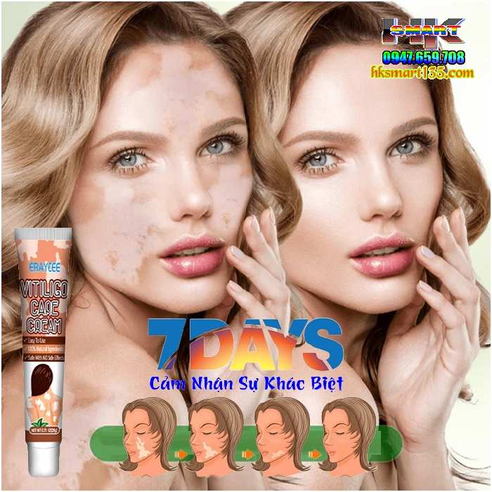 Kem bôi bạch biến lang ben Vitiligo ERAY CEE- 20gr làm mờ bạch biến đốm trắng