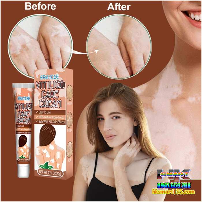 Kem bôi bạch biến lang ben Vitiligo ERAY CEE- 20gr làm mờ bạch biến đốm trắng