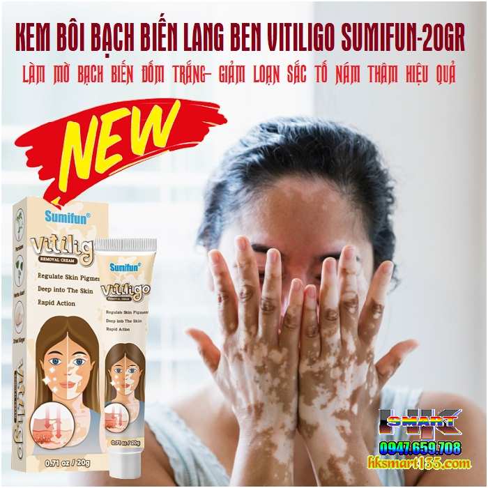 Kem bôi bạch biến lang ben Vitiligo - 20gr làm mờ bạch biến đốm trắng