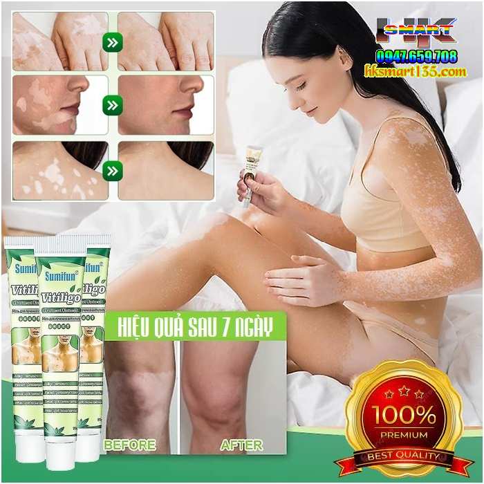 Kem bôi bạch biến lang ben Vitiligo - 20gr làm mờ bạch biến đốm trắng