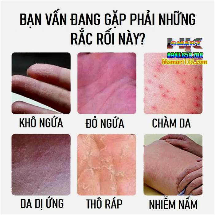 Kem bôi vảy nến HEALMUSZ Psoriasis Ointment xuất Mỹ