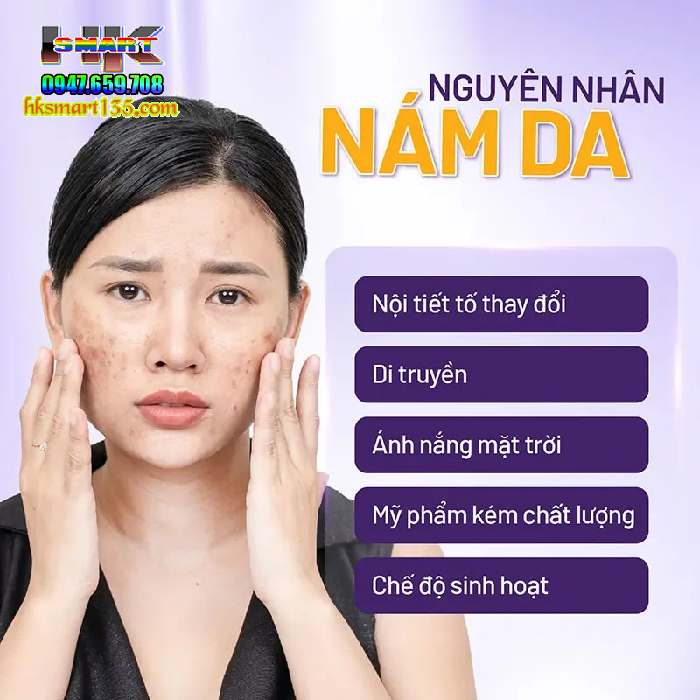 Kem trị nám tàn nhang Clobetamil G