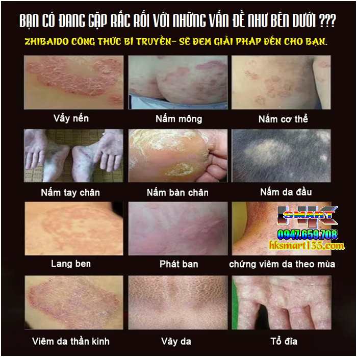 Kem bôi đặc trị viêm da cơ địa, á sừng, vảy nến Zhibaido