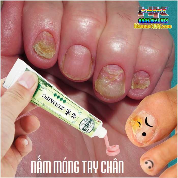 ZUDAIFU 15GR- Kem bôi đặc trị nấm ngứa, nứt nẻ, nấm móng tay chân