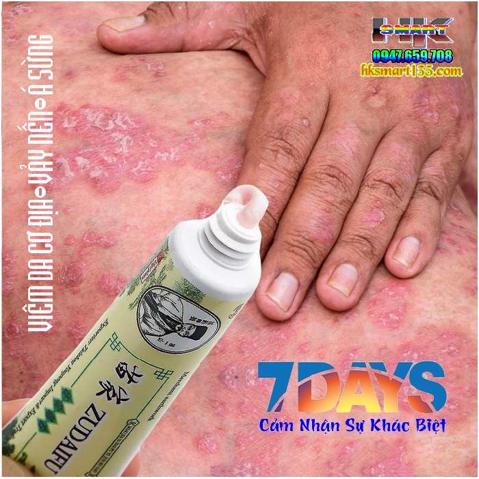 ZUDAIFU 15GR- Kem bôi đặc trị nấm ngứa, nứt nẻ, nấm móng tay chân