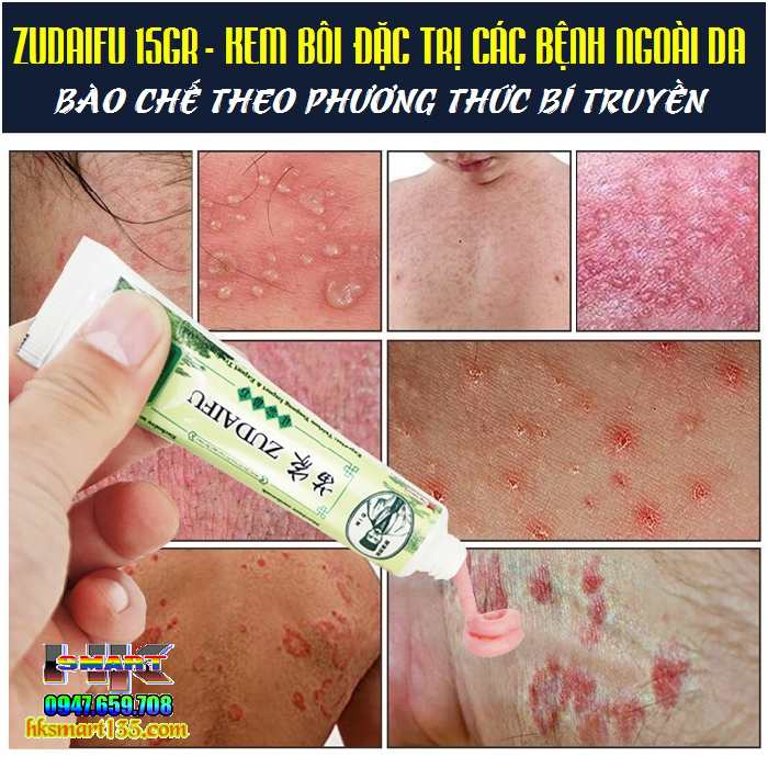 ZUDAIFU 15GR- Kem bôi đặc trị nấm ngứa, nứt nẻ, nấm móng tay chân