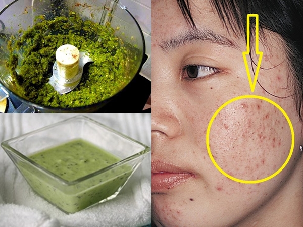 lá ổi trị mụn