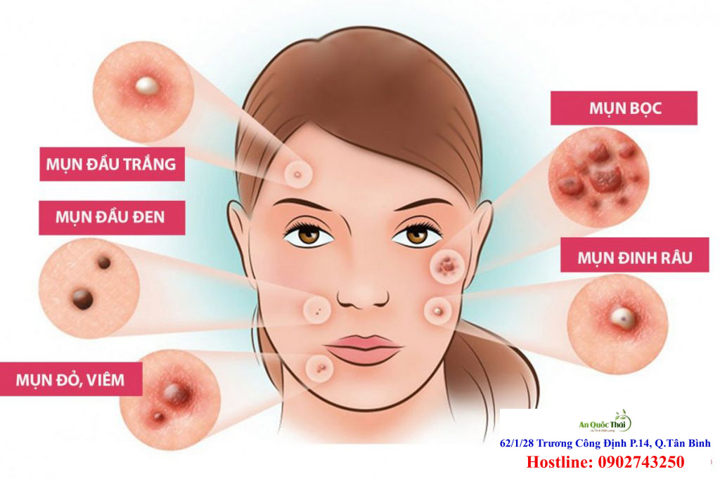 hạt ngũ hoa trị mụn