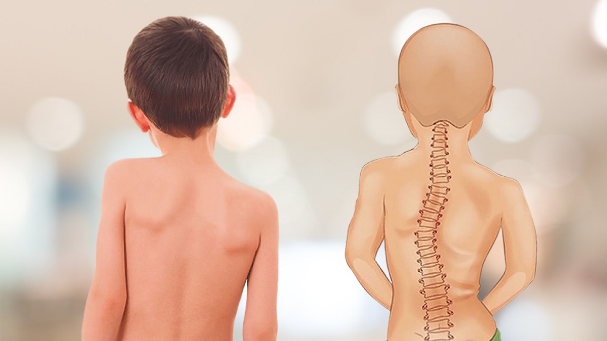 Bàn chân bẹt ảnh hưởng lớn đến cột sống của trẻ