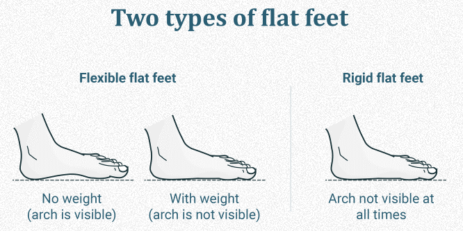 Phân loại bàn chân bẹt
