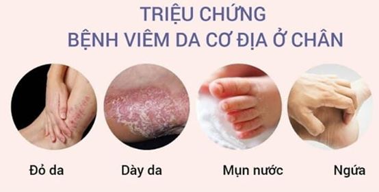 Triệu chứng viêm da cơ địa