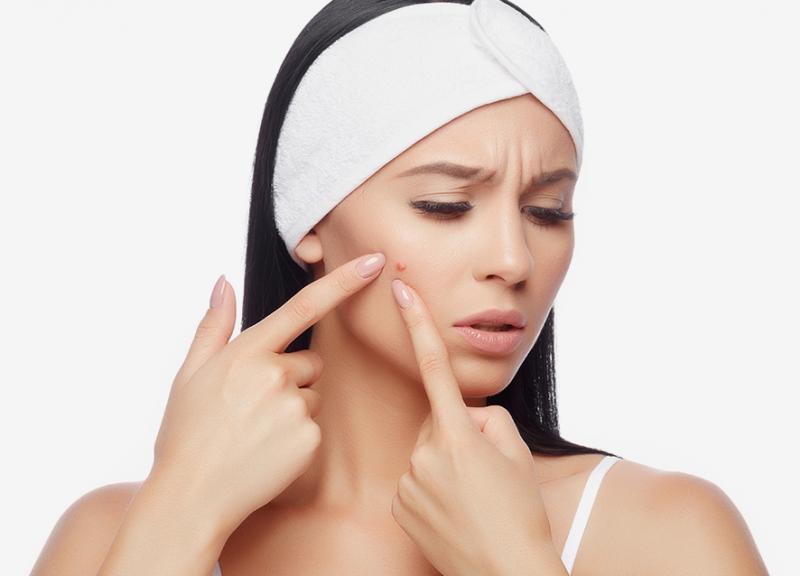 Da nổi quá nhiều mụn