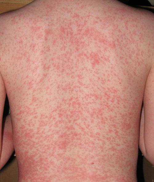 Chăn ga gối đệm bẩn có thể gây kích ứng da