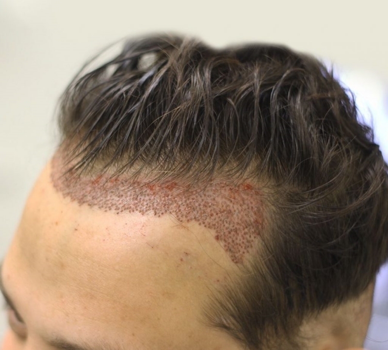 Cấy tóc để điều trị chứng rụng tóc