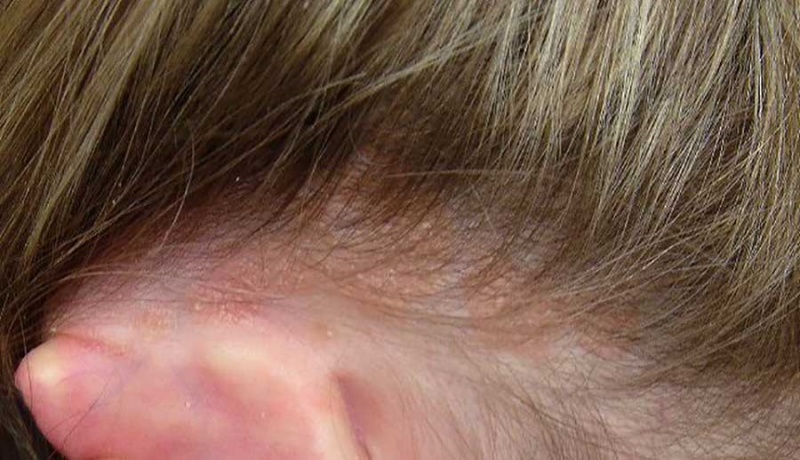 Vẩy nến da đầu