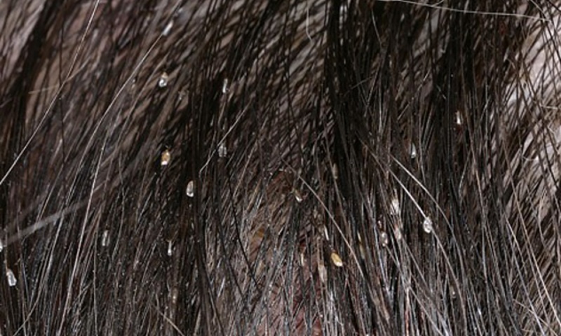 Ngứa da đầu do chấy