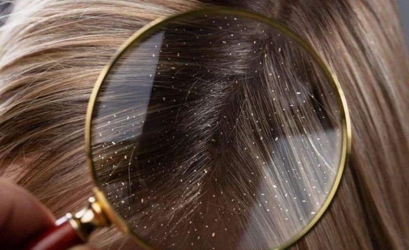 Ngứa do da đầu bị gàu