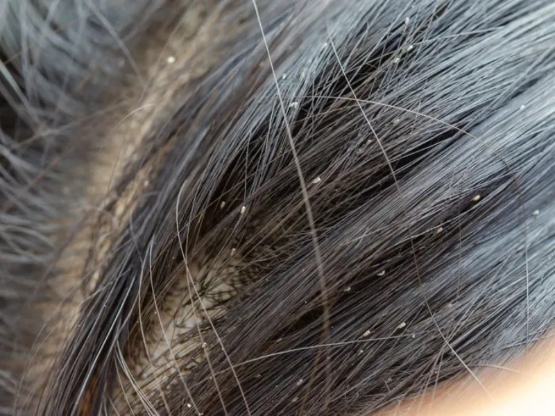 Ngứa da đầu do chấy