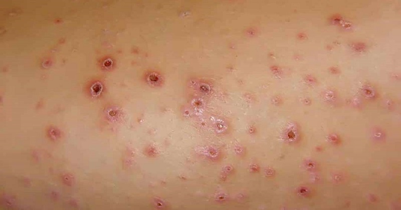 Bệnh li ken phẳng lông