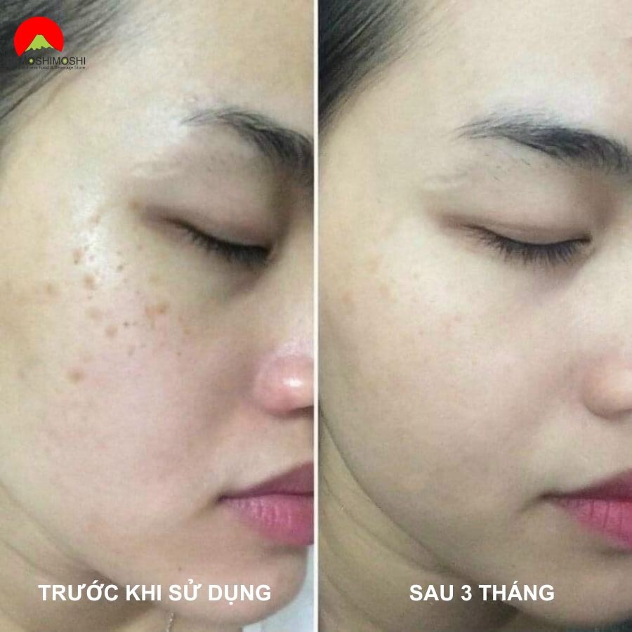 Trước và sau khi dùng mỹ phẩm TRANSINO