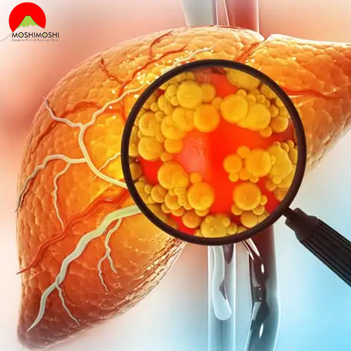 Nguyên nhân gây ra gan nhiễm mỡ