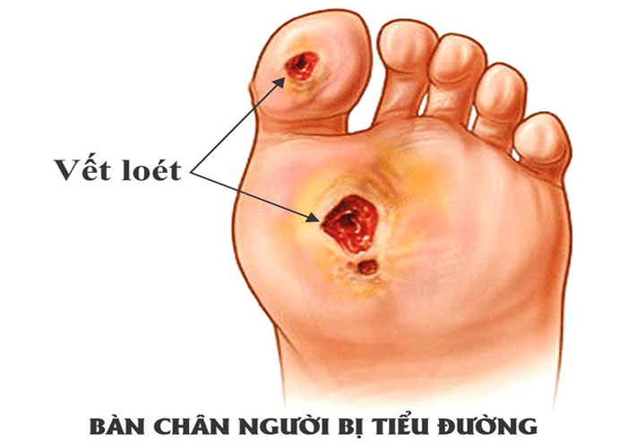 4 quy tắc giúp người tiểu đường khỏi lo suy thận